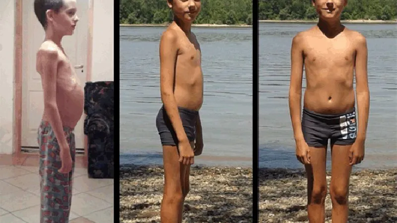 A child with type 1 diabetes successfully treated with the paleolithic ketogenic diet