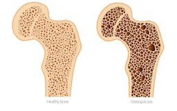 What does low carb do to your bones?