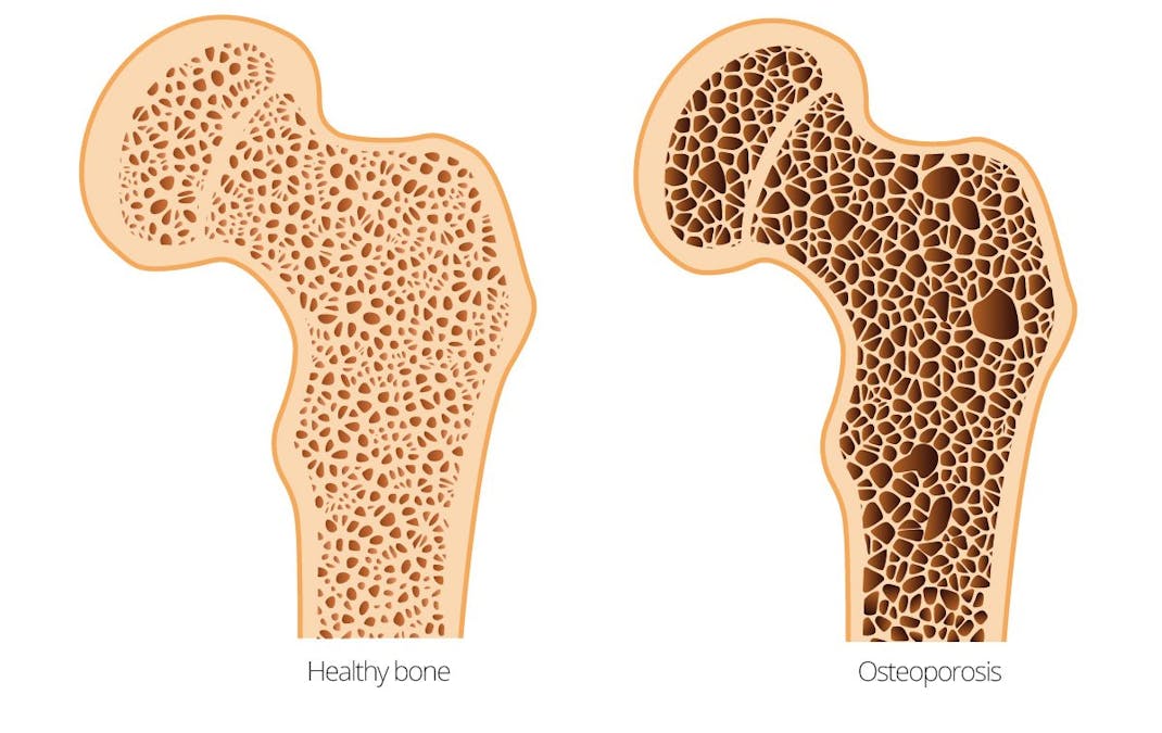 What does low carb do to your bones?