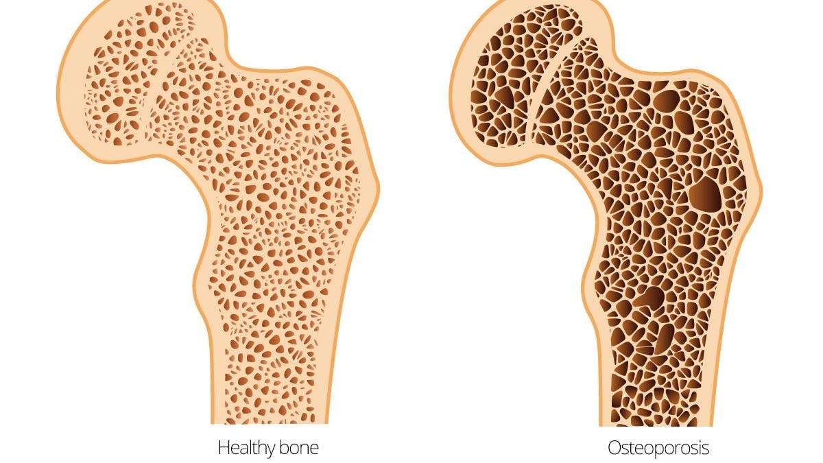 What does low carb do to your bones?