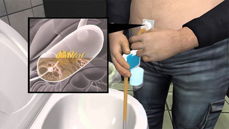 Bulimia device