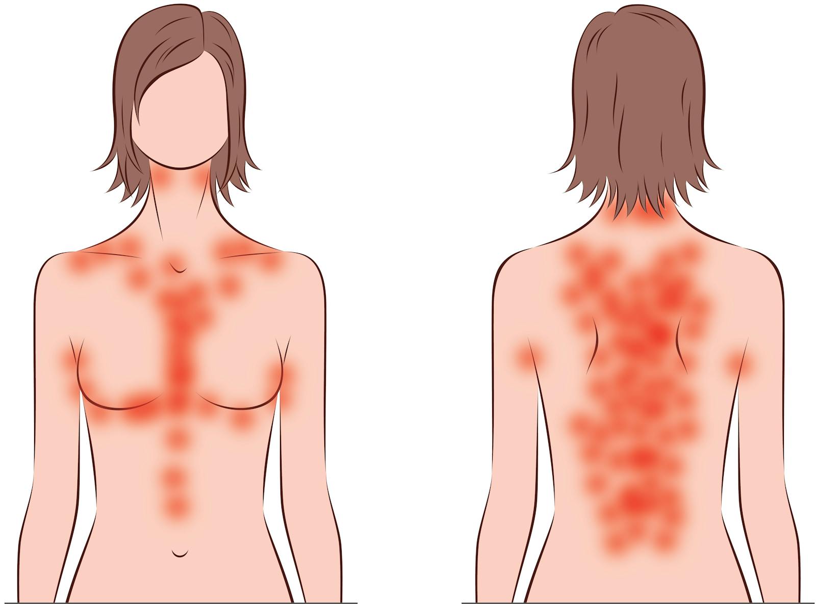 Upper Thigh Connect To Torso. What Area Of Body / Keto Rash - Why You May Itch on Low Carb, and What to Do ...