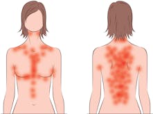 Keto rash – why some people itch on low carb, and what to do about it