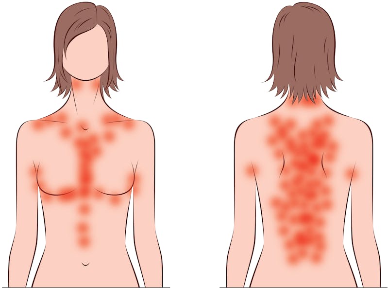 Keto Rash Why You May Itch On Low Carb And What To Do About It
