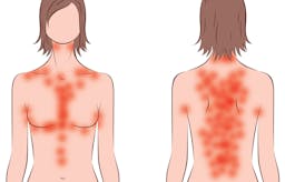 Keto rash – why some people itch on low carb, and what to do about it
