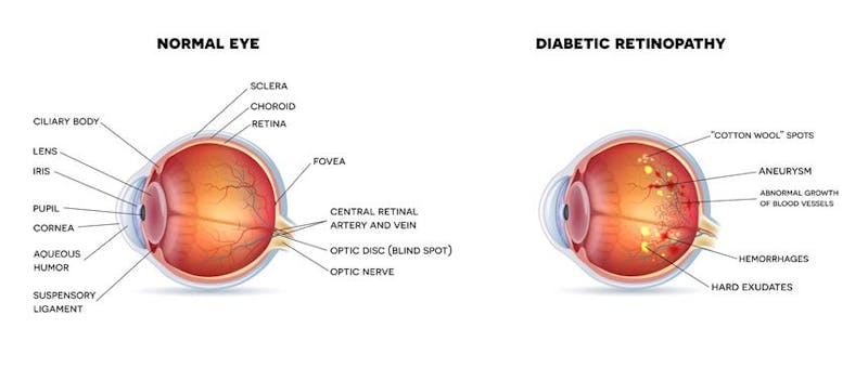 retinopathy-condition