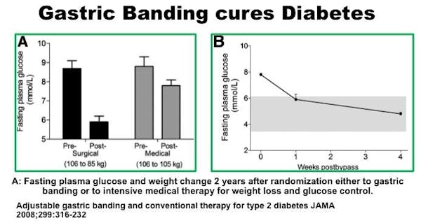 surgerycuresdiabetes5