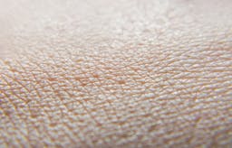 "Within three months of starting a well-formulated ketogenic diet, all flares were gone!"