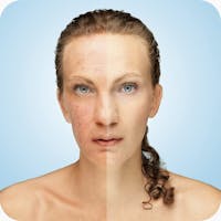 Carb baixo e acne