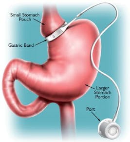 sharma-obesity-adjustable-gastric-banding2
