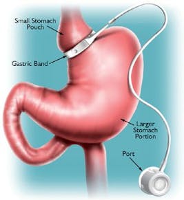sharma-obesity-adjustable-gastric-banding2