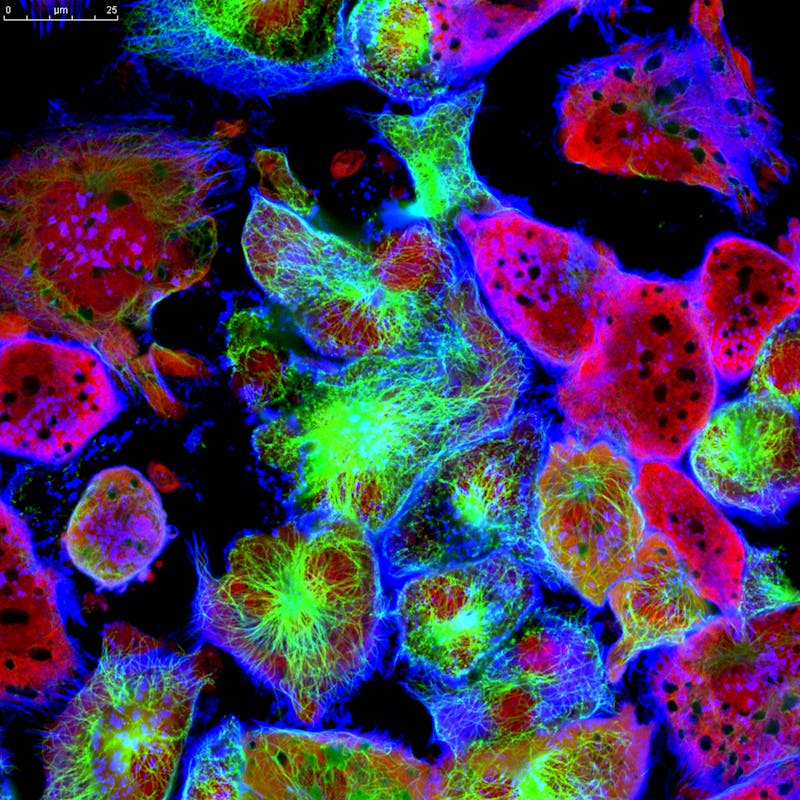Tumor cells under microscope