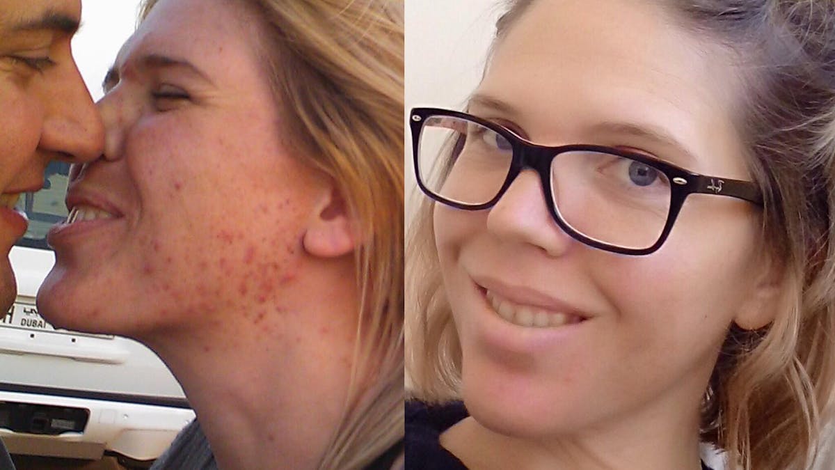 'A combination of LCHF and paleo healed my skin'
