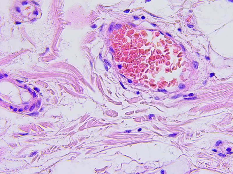 Colon cancer microscopic photograph