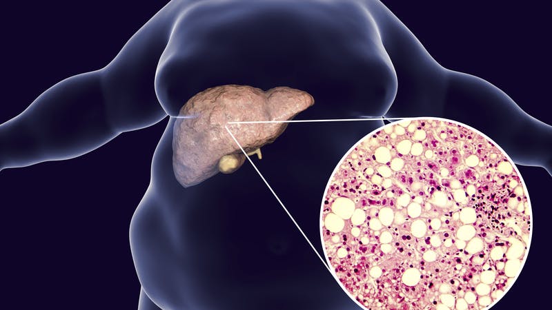 Groundbreaking study: low carb is an effective treatment for fatty liver