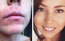 Can a keto diet cure skin disorders?