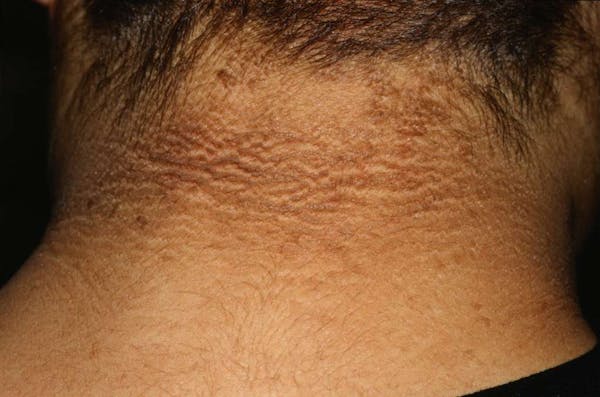 Acanthosis_Nigri