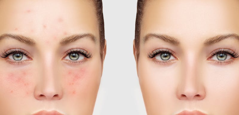 problematic skin without and with makeup