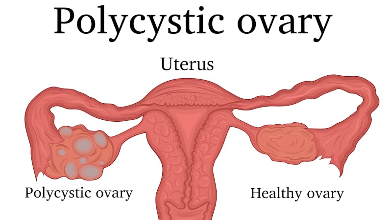 Illustration of Polycystic ovary