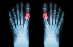 Can we blame gout’s resurgence on ketosis?