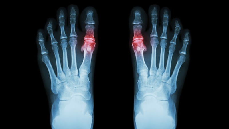 Gout , Rheumatoid arthritis