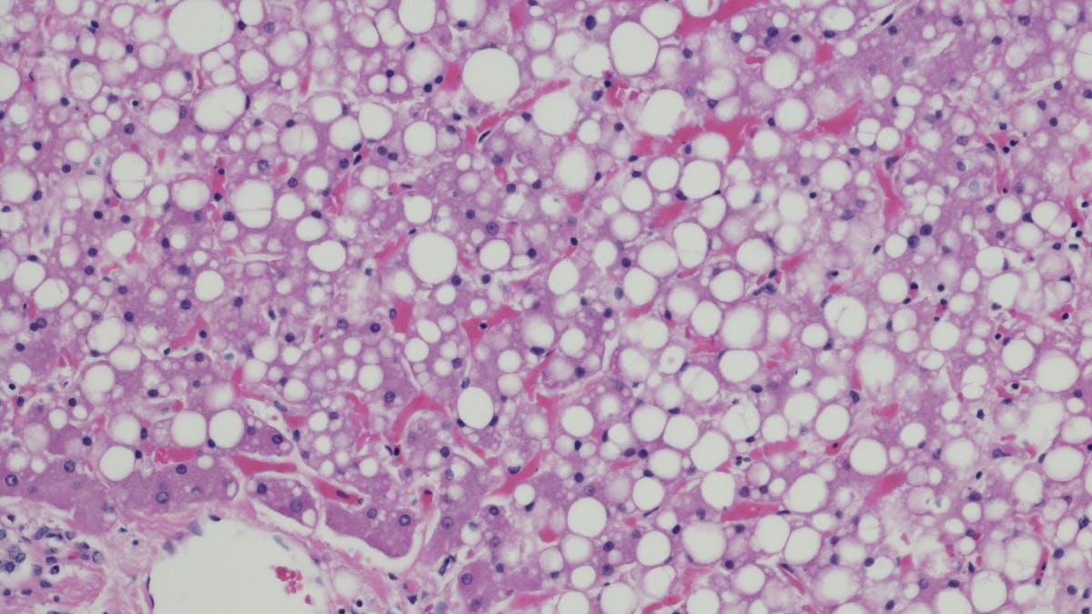 Gut bacteria converting carbs into alcohol may contribute to fatty liver disease