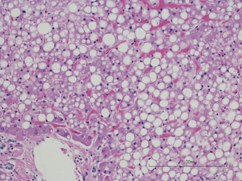 Macrovesicular hepatic steatosis of the liver (fatty liver disease),