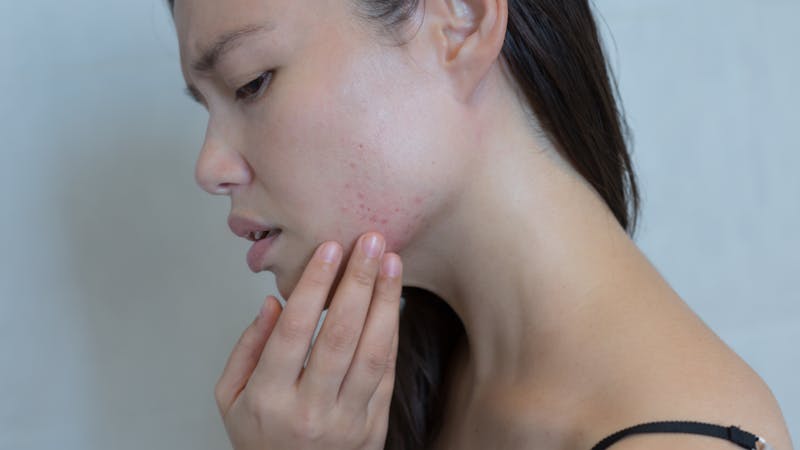 Stressed woman breaking out with acne on her face.