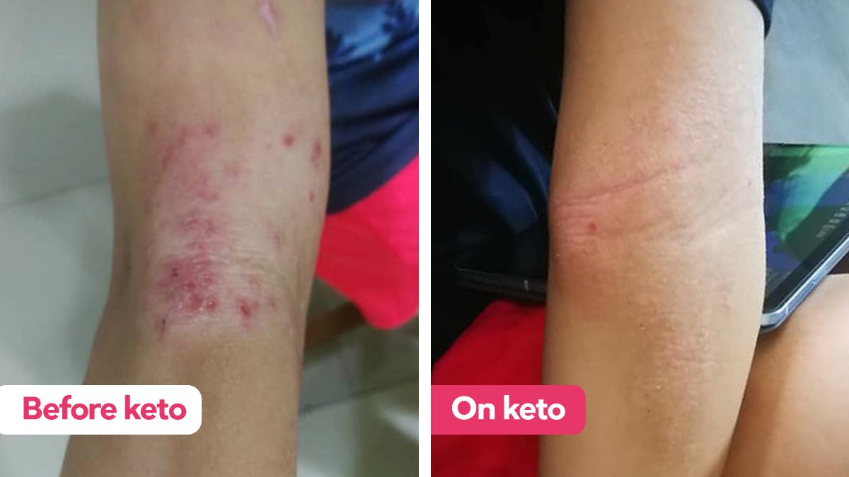 Can a keto diet help treat eczema?