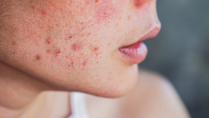 acne on woman’s face with rash skin ,scar and spot that allergic to cosmetics