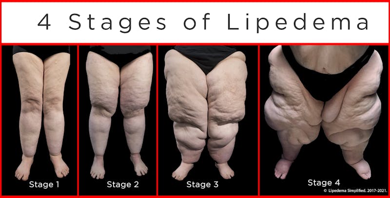 Four stages of lipedema