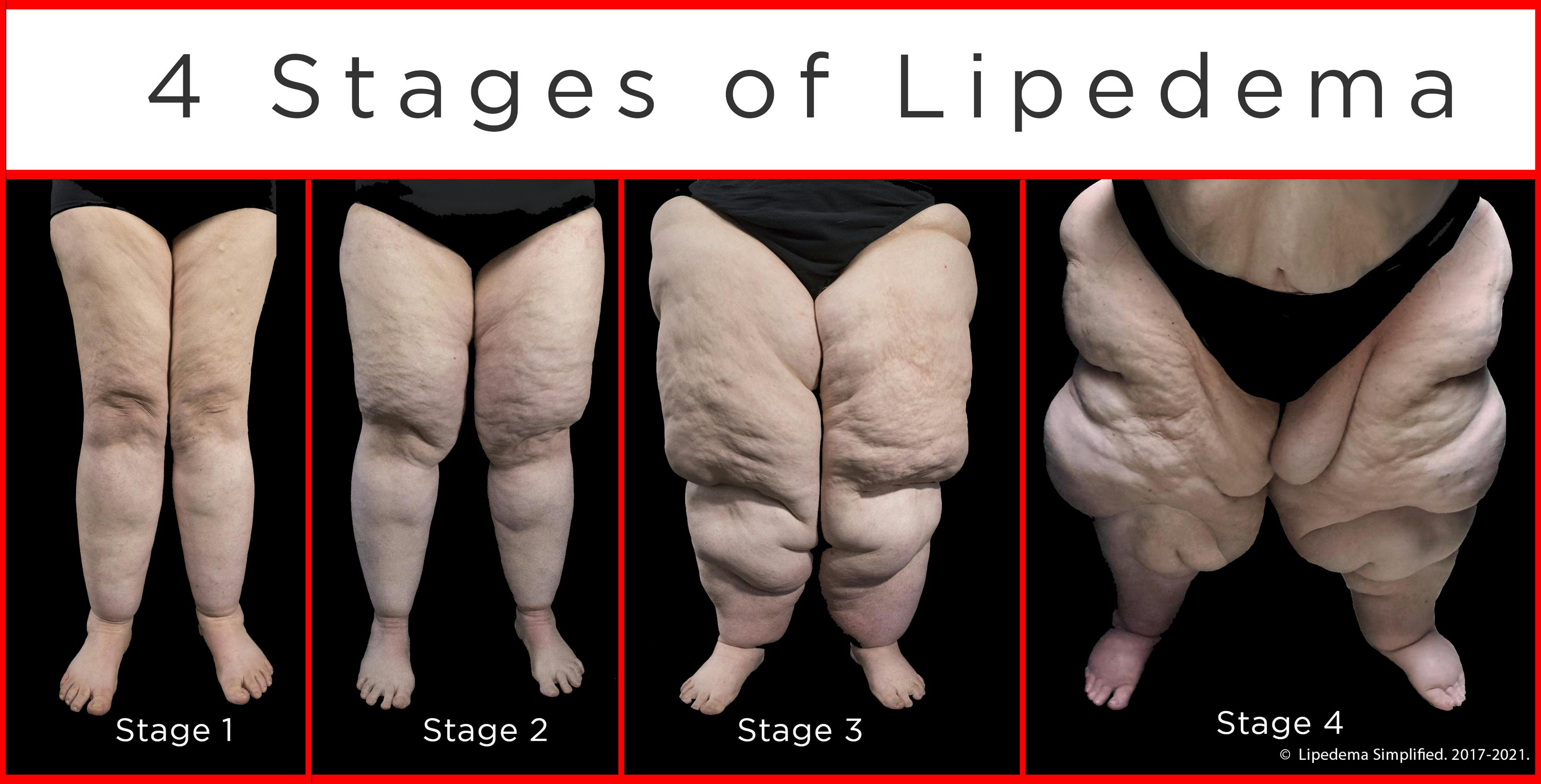Que es el lipedema en piernas Que es el lipedema en piernas