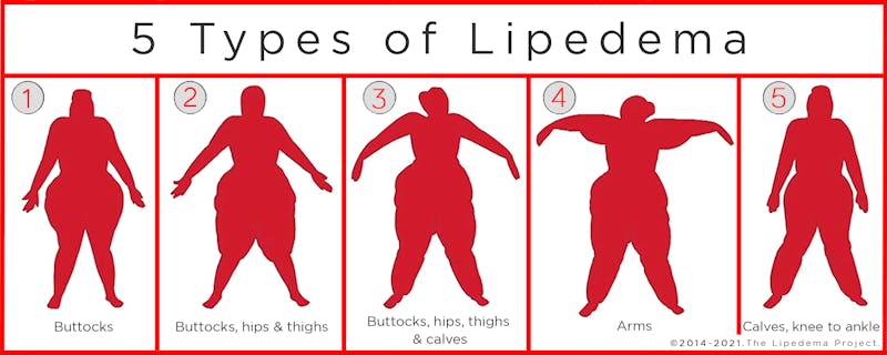 Five types of lipedema