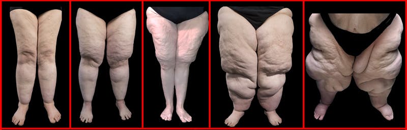 lipedema intro image