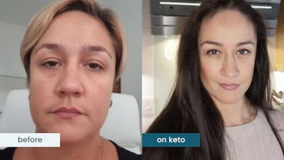Decades of suffering relieved by keto