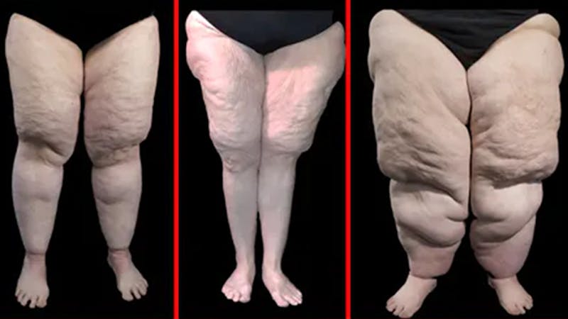 Lipedema, the disease they call FAT  Lymphatic Education & Research Network