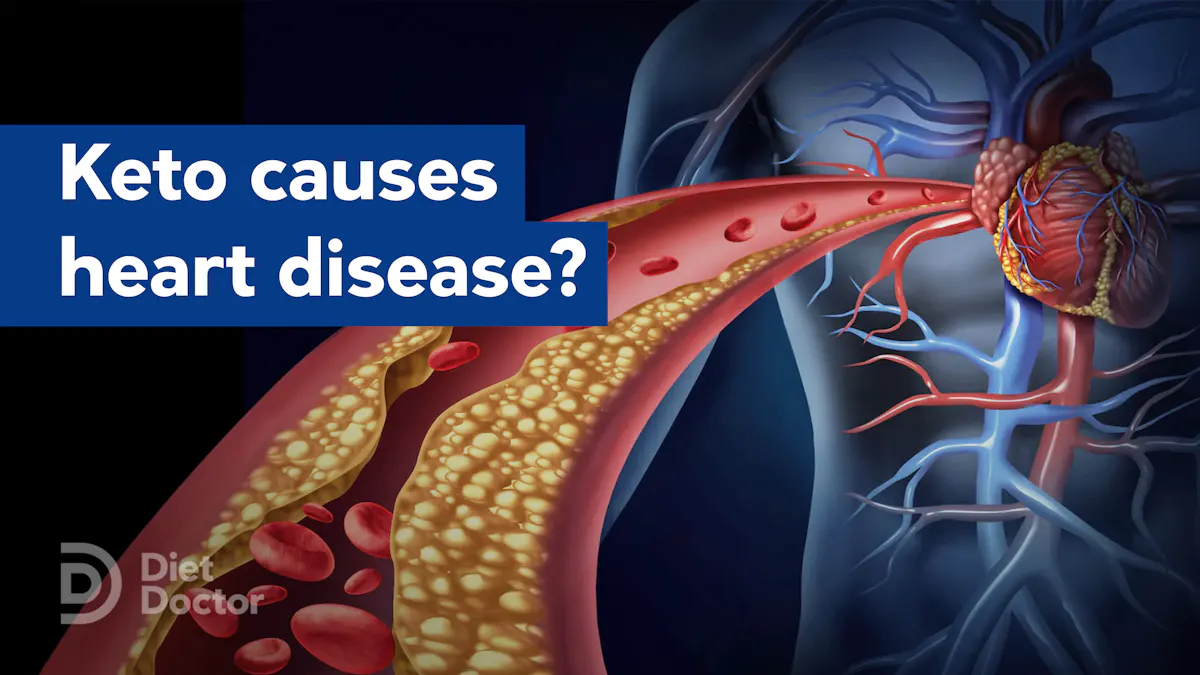 New study: Keto reduces, not raises, cardiovascular risk